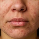 Close-up of perioral dermatitis rash around the mouth