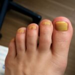 Close-up of toenail fungus